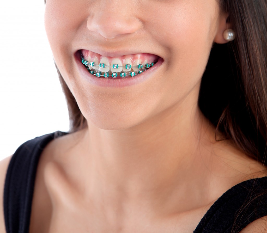 Smiling teenager girl with brackets
